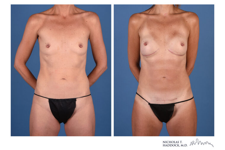 LAP flap Before and After Photo LAP flap Before and After Photo