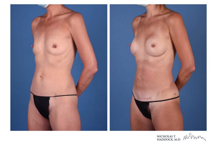 LAP flap Before and After Photo LAP flap Before and After Photo