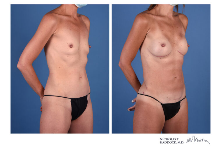 LAP flap Before and After Photo LAP flap Before and After Photo