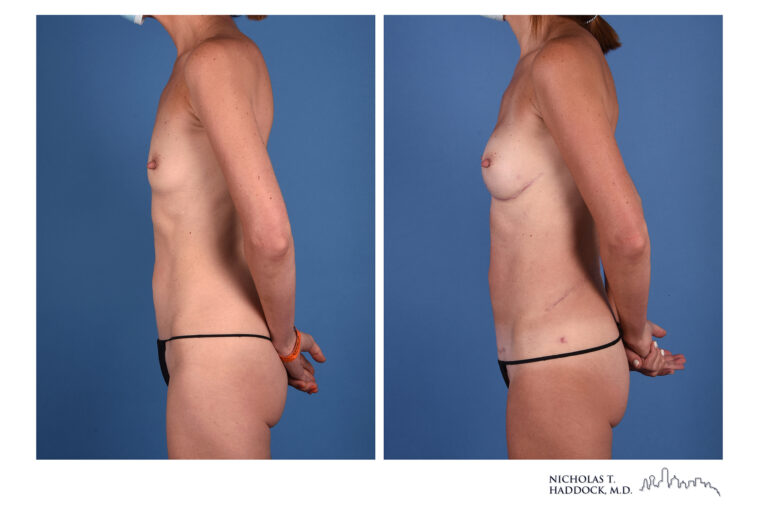 LAP flap Before and After Photo LAP flap Before and After Photo