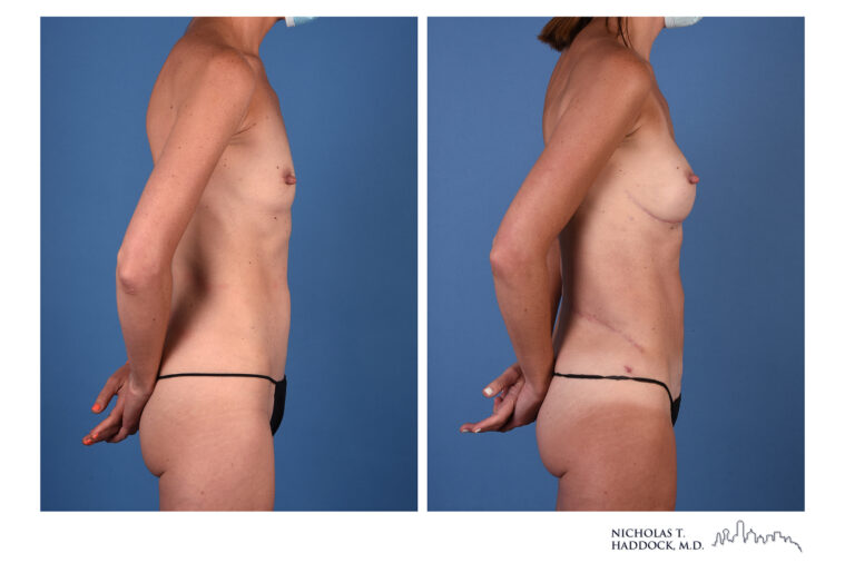 LAP flap Before and After Photo LAP flap Before and After Photo
