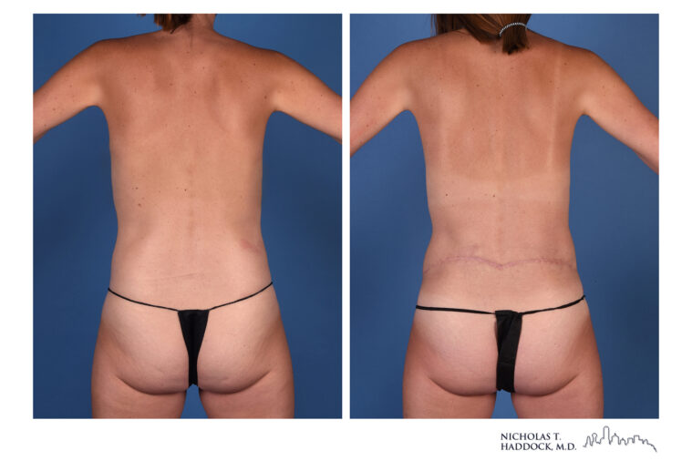 LAP flap Before and After Photo LAP flap Before and After Photo