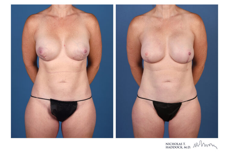 LAP Flap and PAP Flap Before and After LAP Flap and PAP Flap Before and After