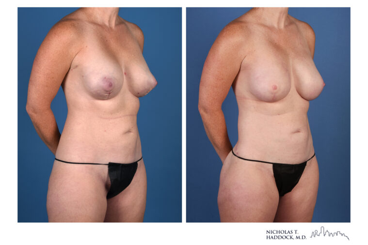 LAP Flap and PAP Flap Before and After LAP Flap and PAP Flap Before and After