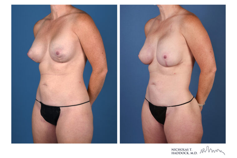 LAP Flap and PAP Flap Before and After LAP Flap and PAP Flap Before and After