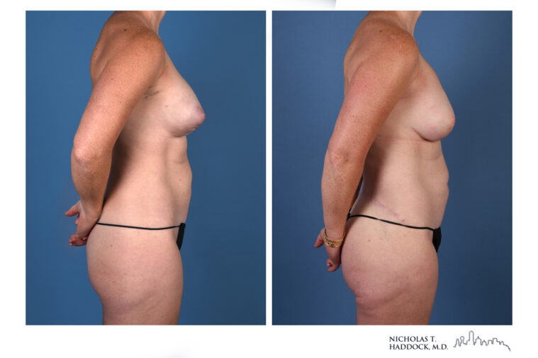LAP Flap and PAP Flap Before and After LAP Flap and PAP Flap Before and After