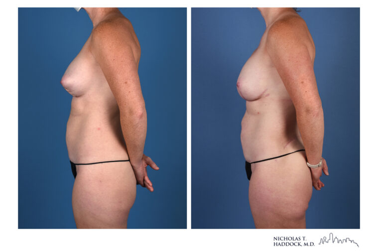 LAP Flap and PAP Flap Before and After LAP Flap and PAP Flap Before and After