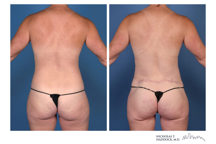 LAP Flap and PAP Flap Before and After LAP Flap and PAP Flap Before and After