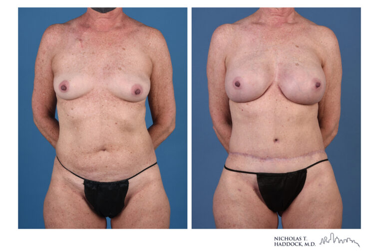 DIEP Flap and LAP flap Before and After Photo DIEP Flap and LAP flap Before and After Photo
