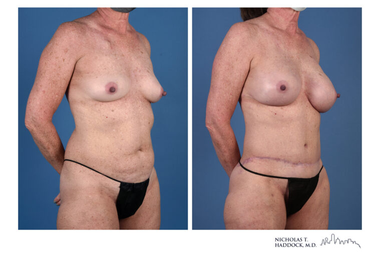 DIEP Flap and LAP flap Before and After Photo DIEP Flap and LAP flap Before and After Photo