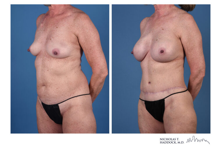 DIEP Flap and LAP flap Before and After Photo DIEP Flap and LAP flap Before and After Photo