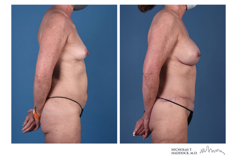 DIEP Flap and LAP flap Before and After Photo DIEP Flap and LAP flap Before and After Photo