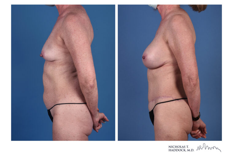 DIEP Flap and LAP flap Before and After Photo DIEP Flap and LAP flap Before and After Photo