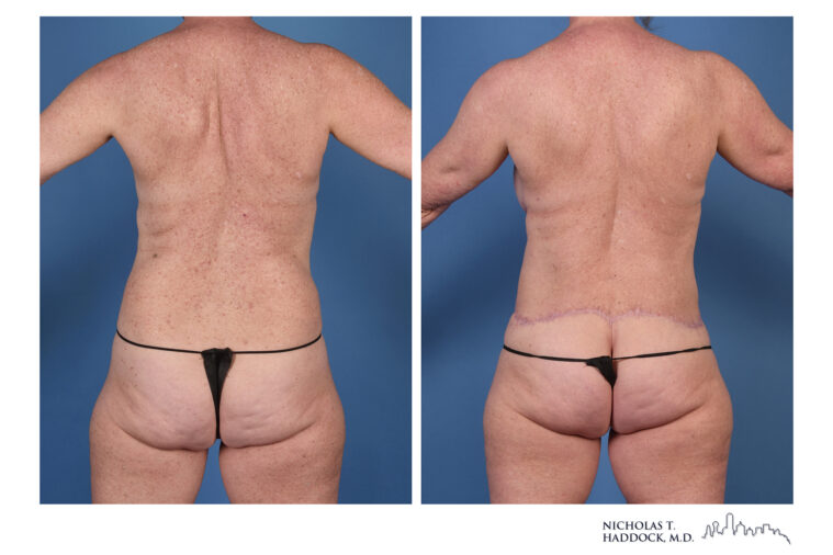 DIEP Flap and LAP flap Before and After Photo DIEP Flap and LAP flap Before and After Photo