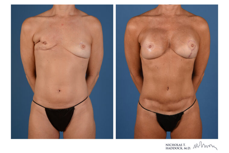 Double DIEP Flap Before and After Double DIEP Flap Before and After