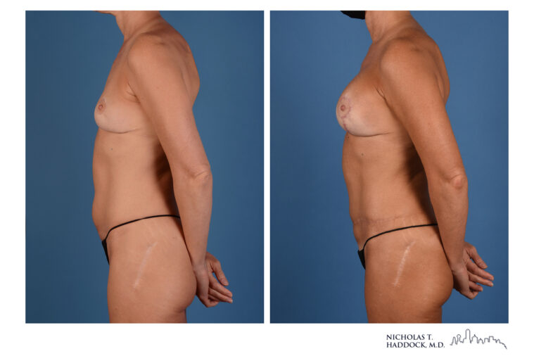 Double DIEP Flap Before and After Double DIEP Flap Before and After