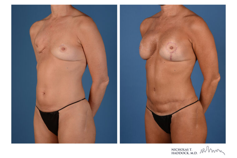 Double DIEP Flap Before and After Double DIEP Flap Before and After