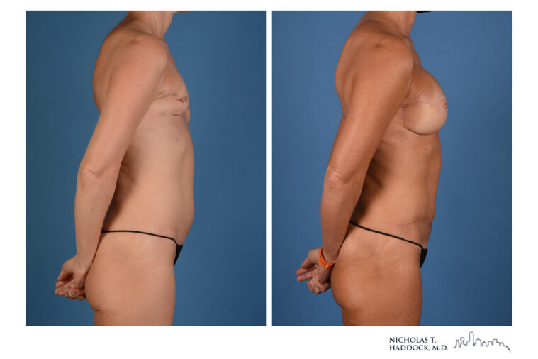 Double DIEP Flap Before and After Double DIEP Flap Before and After