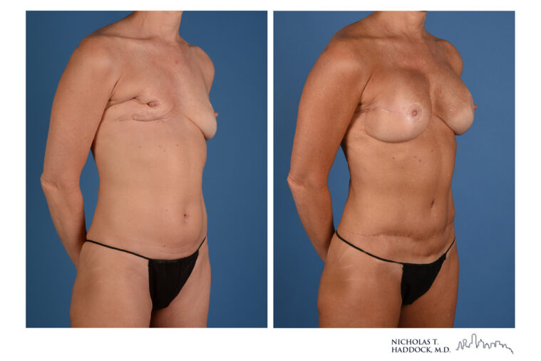 Double DIEP Flap Before and After Double DIEP Flap Before and After