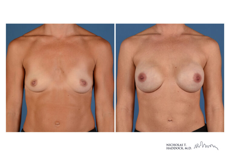 Implant Breast Reconstruction Before and After Photo Implant Breast Reconstruction Before and After Photo