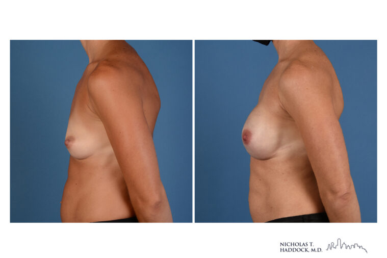 Implant Breast Reconstruction Before and After Photo Implant Breast Reconstruction Before and After Photo