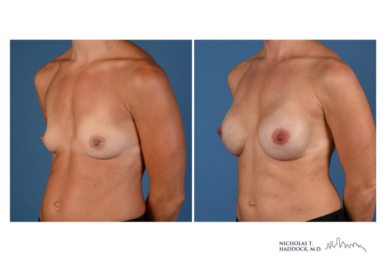 Implant Breast Reconstruction Before and After Photo Implant Breast Reconstruction Before and After Photo