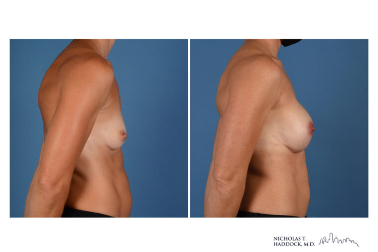 Implant Breast Reconstruction Before and After Photo Implant Breast Reconstruction Before and After Photo