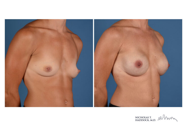 Implant Breast Reconstruction Before and After Photo Implant Breast Reconstruction Before and After Photo