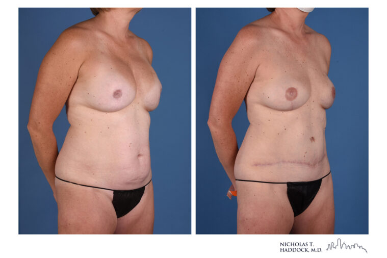 DIEP Before and After DIEP Before and After