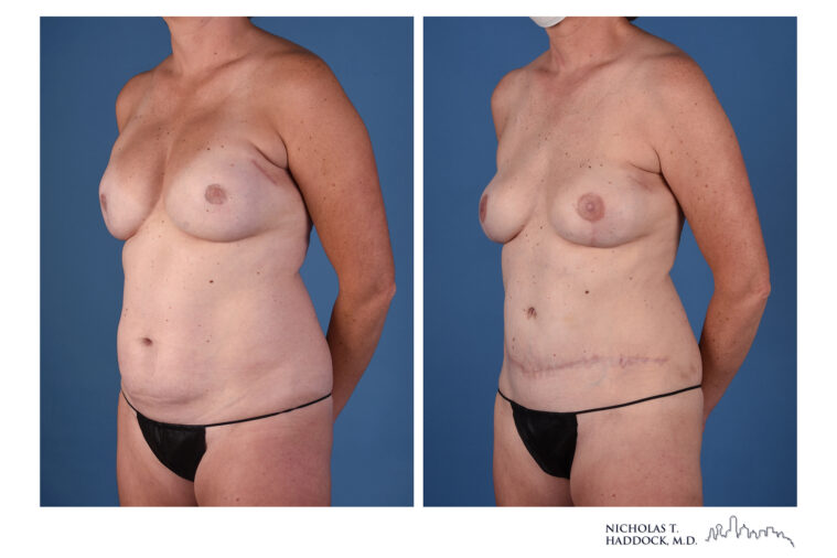 DIEP Before and After DIEP Before and After