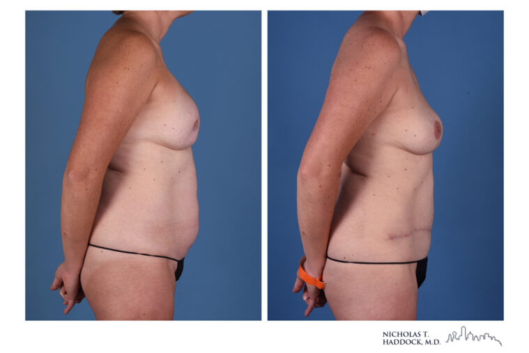 DIEP Before and After DIEP Before and After