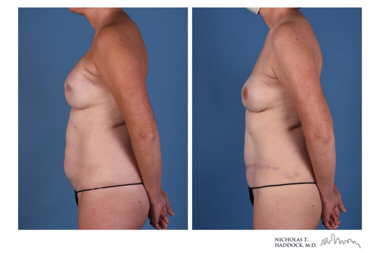 DIEP Before and After DIEP Before and After