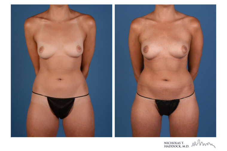 PAP flap Before and After Photo PAP flap Before and After Photo