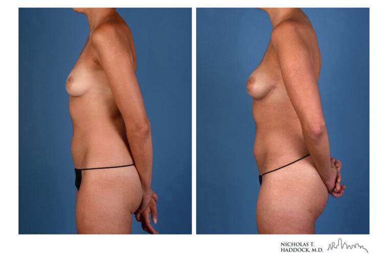 PAP flap Before and After Photo PAP flap Before and After Photo