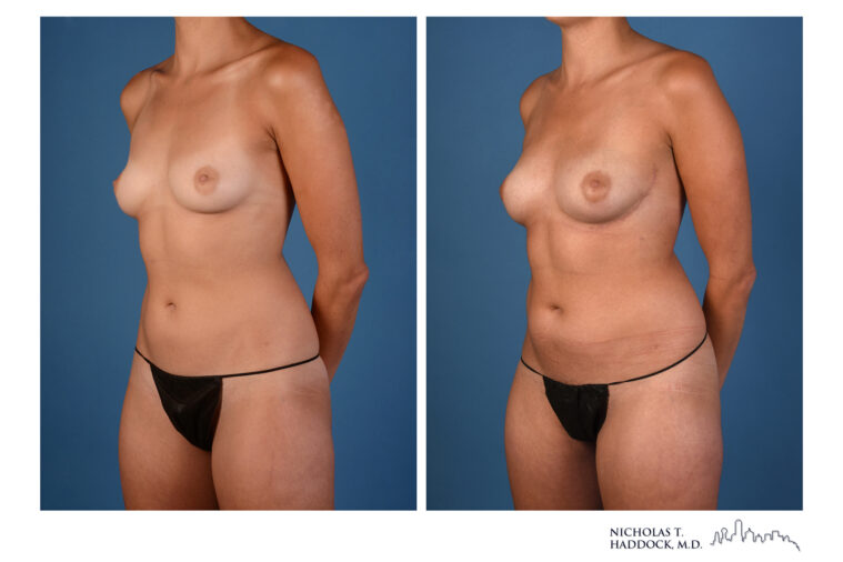 PAP flap Before and After Photo PAP flap Before and After Photo