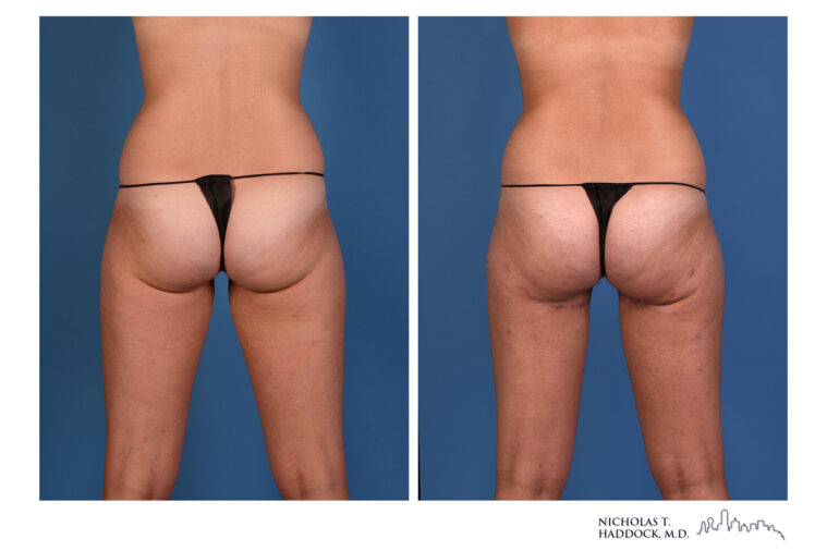 PAP flap Before and After Photo PAP flap Before and After Photo