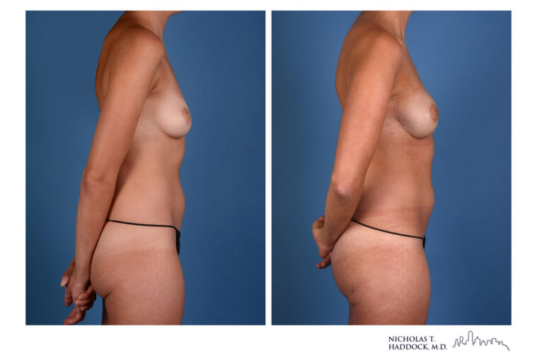 PAP flap Before and After Photo PAP flap Before and After Photo