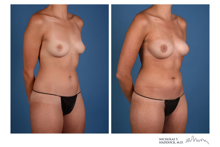 PAP flap Before and After Photo PAP flap Before and After Photo