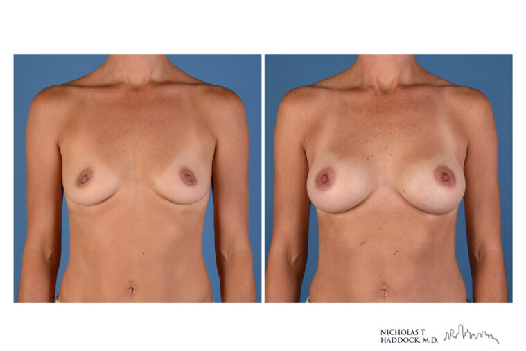 Breast Augmentation breast augmentation