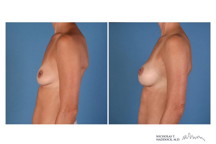 Breast Augmentation breast augmentation