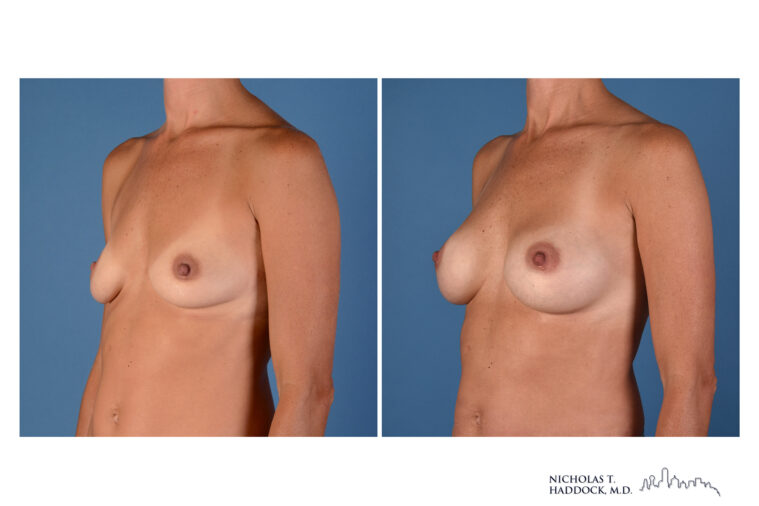 Breast Augmentation breast augmentation