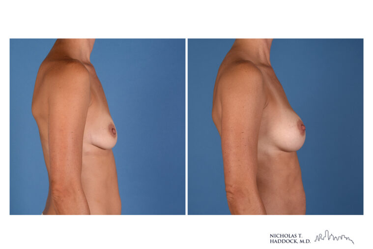 Breast Augmentation breast augmentation