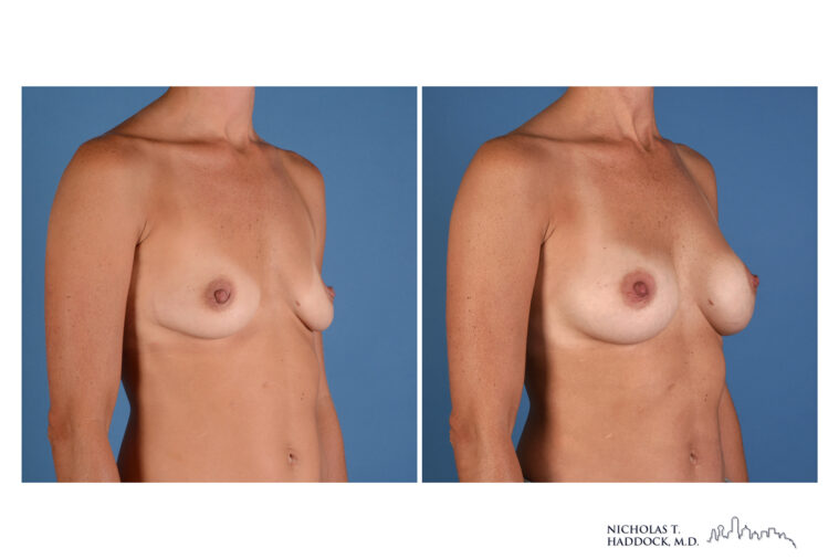 Breast Augmentation breast augmentation