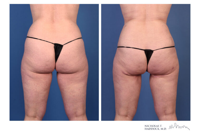 rNSM PAP Flap Breast Reconstruction