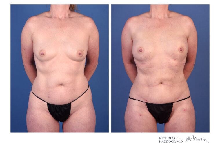 rNSM PAP Flap Breast Reconstruction
