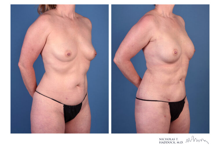 rNSM PAP Flap Breast Reconstruction