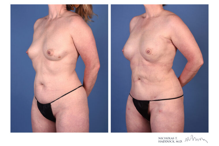 rNSM PAP Flap Breast Reconstruction