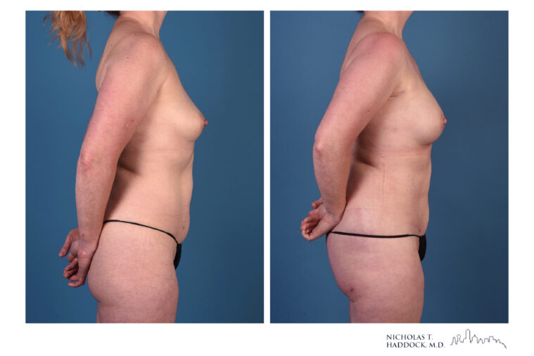 rNSM PAP Flap Breast Reconstruction