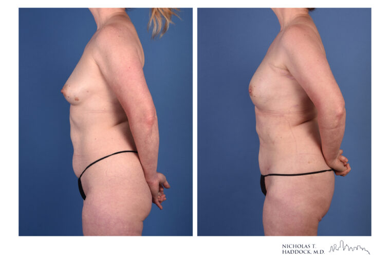 rNSM PAP Flap Breast Reconstruction