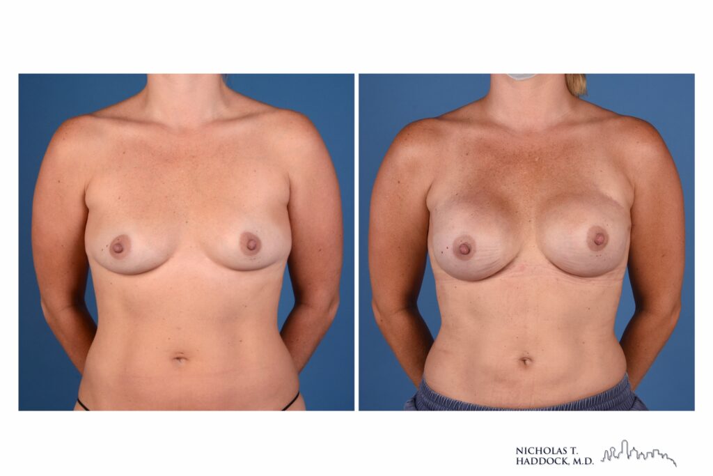 Robotic nipple-sparing mastectomy before and after, front view &mdash; before on the left, after on the right (case 1 of 2)